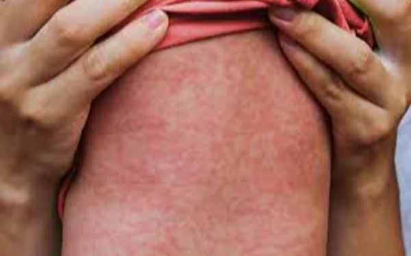 Thumbnail Kemenkes Menyatakan KLB Campak di 31 Provinsi