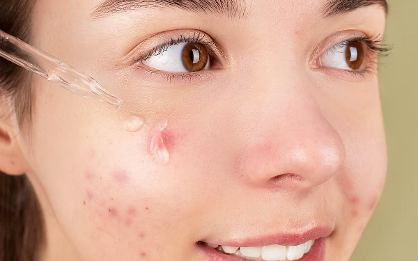 Thumbnail Cara Menghilangkan Bekas Jerawat Pada Kulit Sensitif