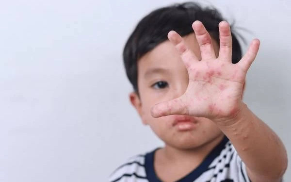 Thumbnail Flu Singapura di Jember Capai 251 Kasus, Dominan Menjangkit Balita