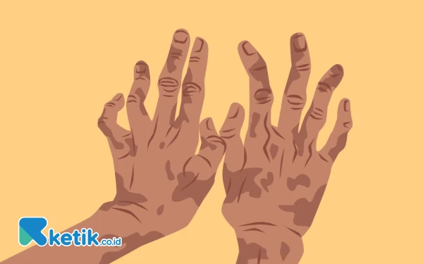 Thumbnail 2.172 Kasus Kusta di Jatim Terus Menurun, 90 Persen Sembuh