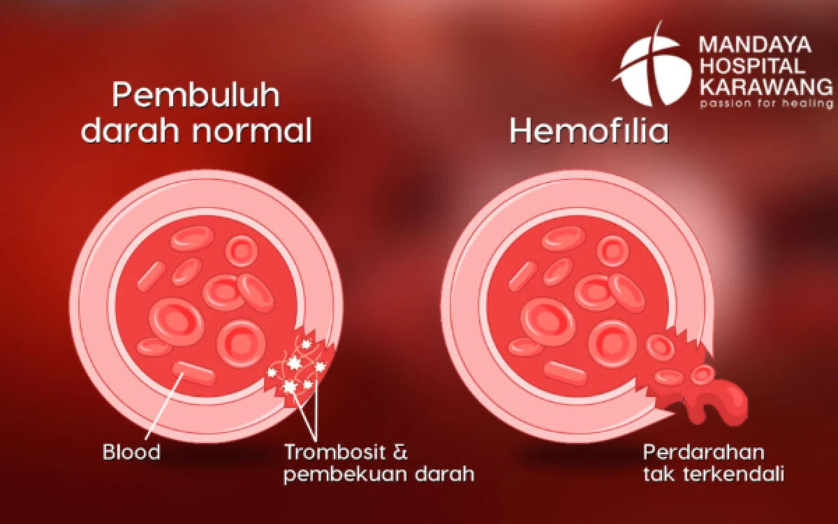 Banyak Kasus Hemofilia Baru Terungkap Setelah Perdarahan, Dokter Soroti Minimnya Deteksi Dini