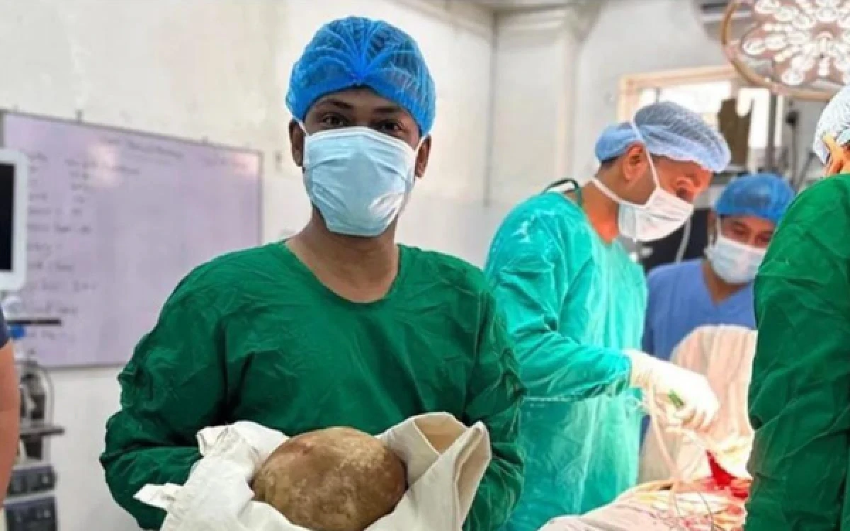 Thumbnail Berita - Batu 3,1 Kilogram Bersarang di Kandung Kemih hingga 10 Tahun Berhasil Diangkat di Sri Lanka